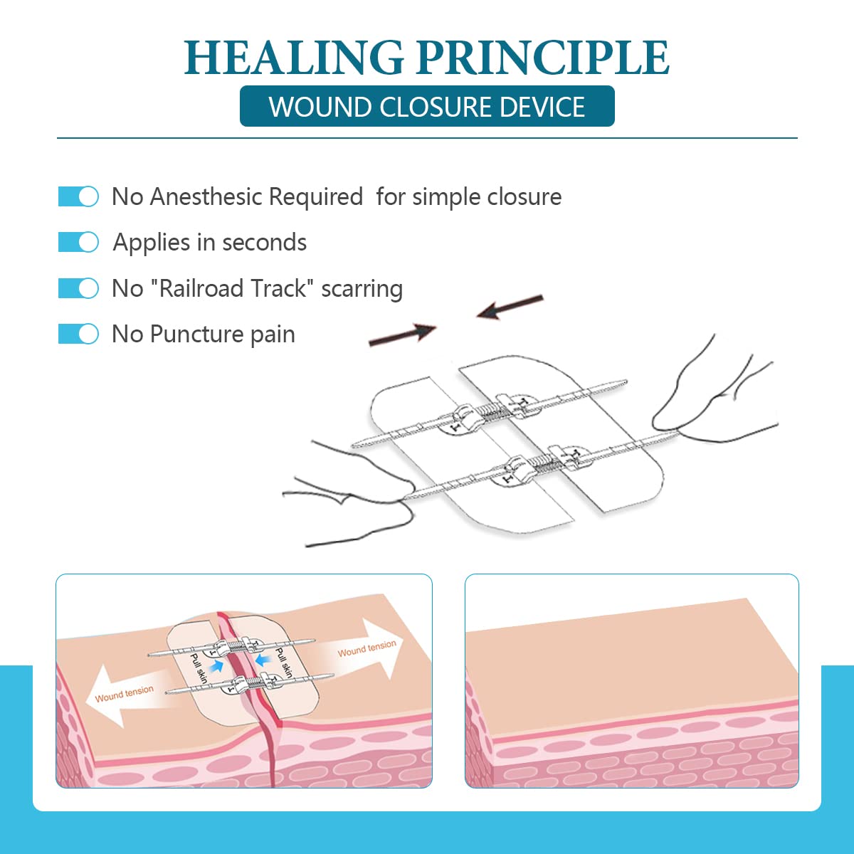 Sutures Butterfly Bandaids - 4 Pcs Laceration Kit - Surgical Laceration Repair Without Sew - Quick Clot -Emergency Wound Closures Device (PU)