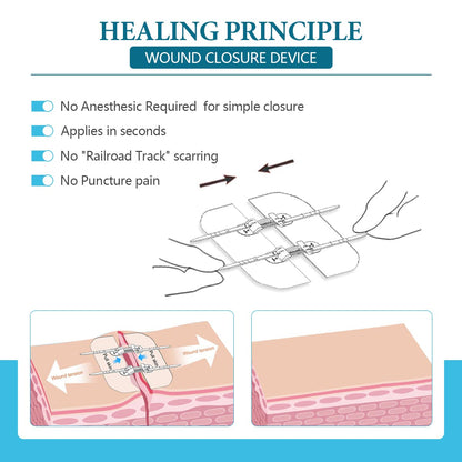 Sutures Butterfly Bandaids - 4 Pcs Laceration Kit - Surgical Laceration Repair Without Sew - Quick Clot -Emergency Wound Closures Device (PU)