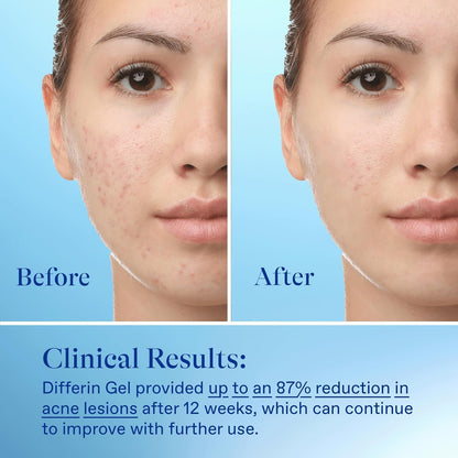 Differin Acne Treatment Gel, 60 Day Supply, Retinoid Treatment for Face with 0.1% Adapalene, Gentle Skin Care for Acne Prone Sensitive Skin, 15g Tube (Pack of 2) (Packaging May Vary)