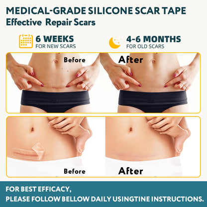 Silicone Scar Sheets, Silicone Scar Tape for Surgical Scars - 60" x 1.6" Roll - 1.5M, Medical Grade Reusable Effective Scar Removal for Keloid, C-Section, Tummy Tuck, and Acne