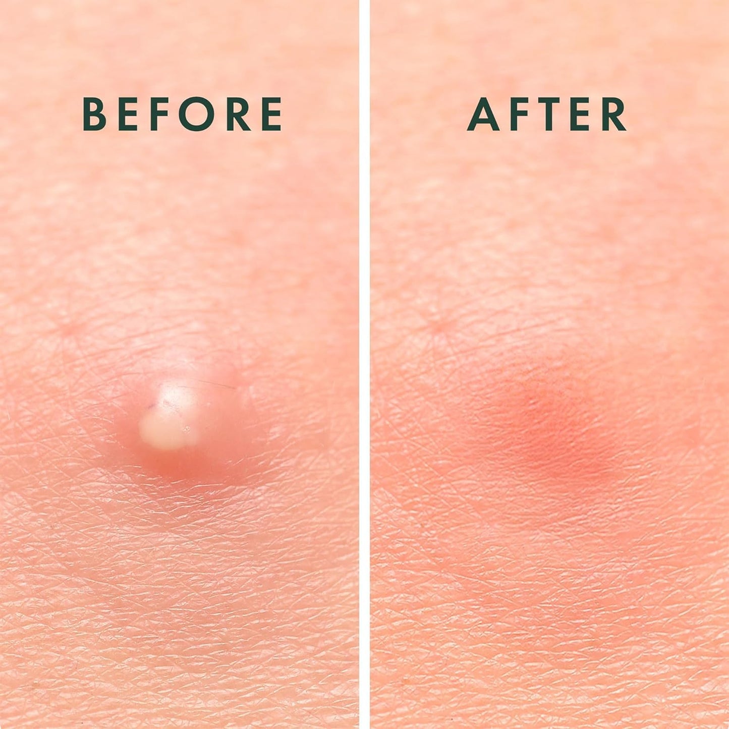 Rael Pimple Patches, Miracle Invisible Spot Cover - Hydrocolloid Acne Patch, Treatment for Breakouts, Absorbs Zits & Blemish, Korean Skin Care, 2 Sizes (96 Count)