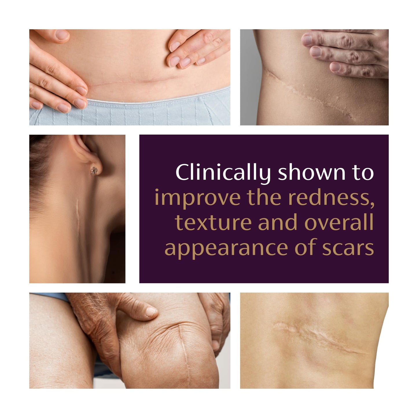 Mederma Advanced Scar Gel - Treats Old & New Scars, Reduces Appearance of Scars from Acne, Surgery, Burns, Injury & Stretch Marks, 0.70 Oz (20g)