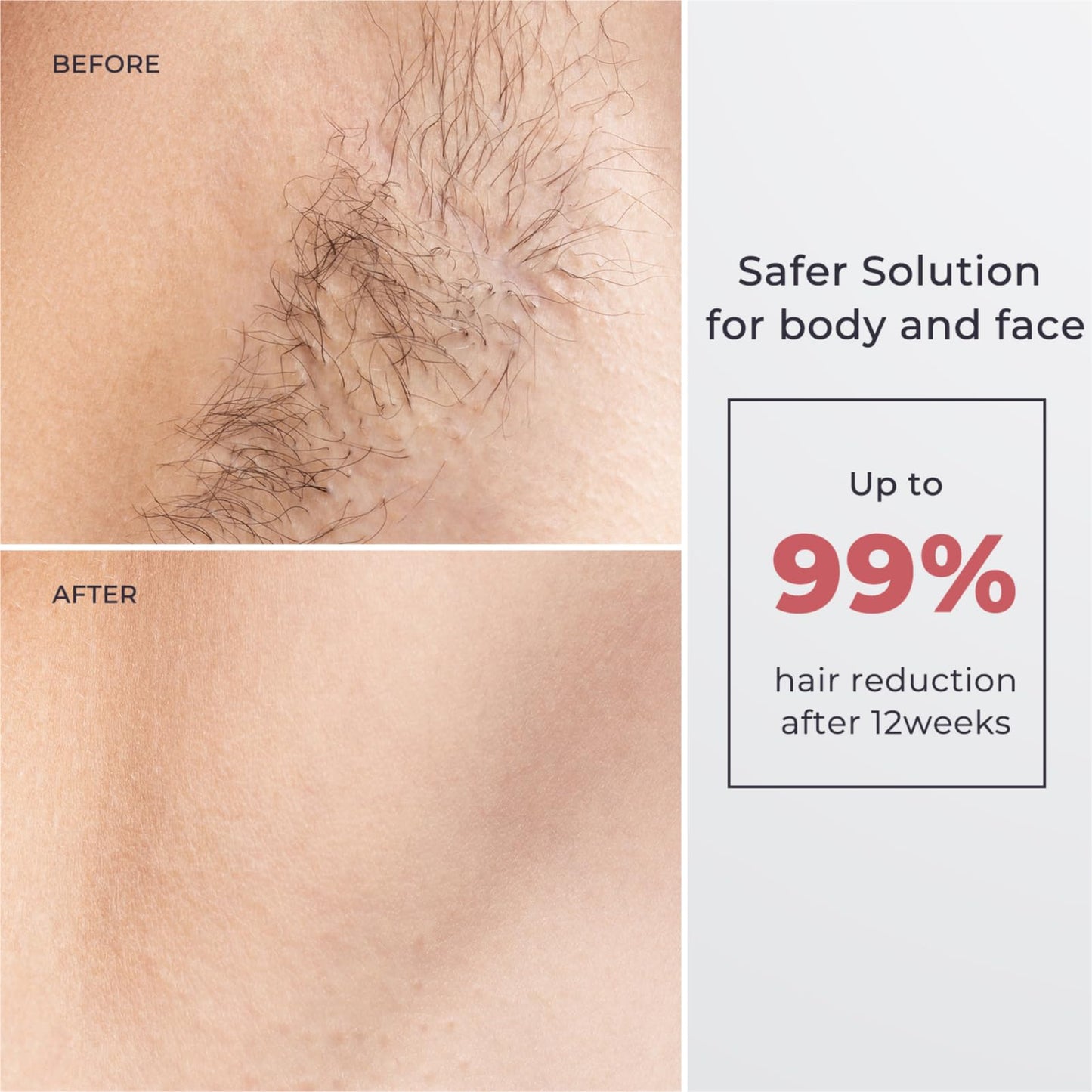 Laser Hair Removal for Women and Men, IPL with Ice-Cooling System for Nearly Painless And Long-Lasting Result At-Home Permanent Hair Removal Device 999999 Flashes for Whole Body Use
