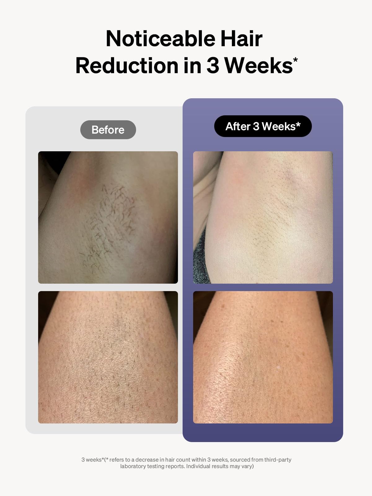 Ulike Laser Hair Removal for Women and Men, Air 3 IPL Hair Removal with Sapphire Ice-Cooling System for Nearly Painless & Long-Lasting Result, Flat-Head Window for Body & Face at-Home Use