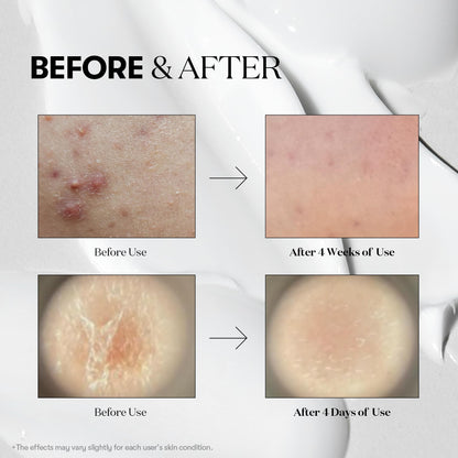 VT COSMETICS CICA Reedle Shot 100, Spicule Microneedling Serum for Pore Care & Exfoliation, Exosome, Centella Asiatica for Glass Skin, Skin Texture, Korean Liquid Skin Booster (1.69 Fl Oz / 50ml)