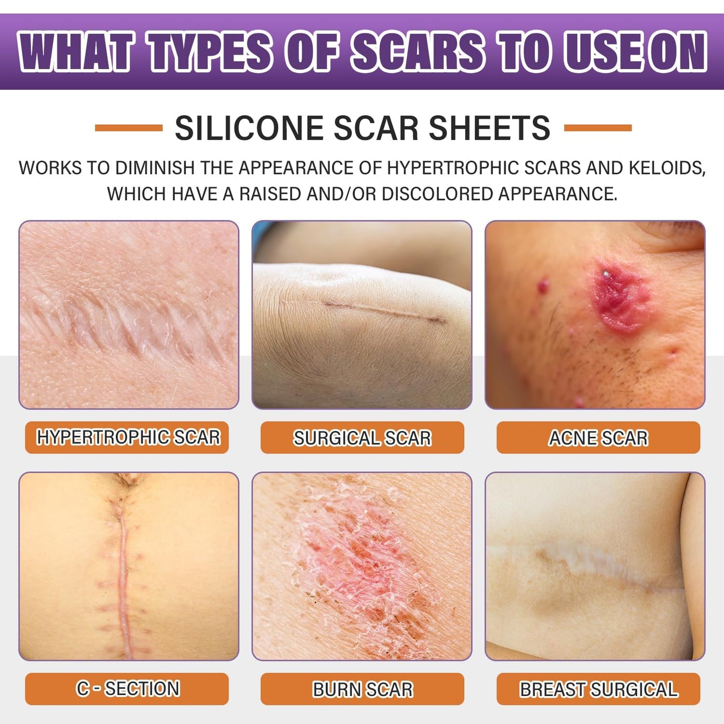 Silicone Scar Sheets,Silicone Scar Tape,Scar Tape for Surgical,C-Section,Tummy Tuck,Keloid(1.6"X 120" Roll-3M) Keloid Bump Removal