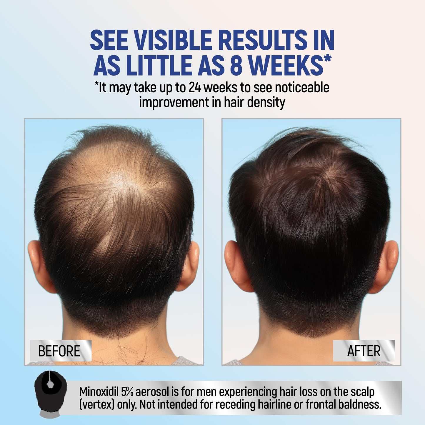 Minoxidil Topical Aerosol Foam, 5%, Hair Regrowth 4 Months Treatment for Men, 2.11 oz (4 Pack)