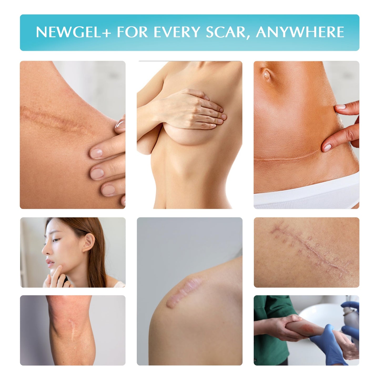 Advanced High-Potency Silicone Scar Gel with Vitamin E for Old, New Scars, Surgery, Keloids, Burns, and Facial Blemish Scars, NewGel Plus by MyNewGel (15 Grams) - 0.50 oz