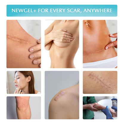 Advanced High-Potency Silicone Scar Gel with Vitamin E for Old, New Scars, Surgery, Keloids, Burns, and Facial Blemish Scars, NewGel Plus by MyNewGel (15 Grams) - 0.50 oz