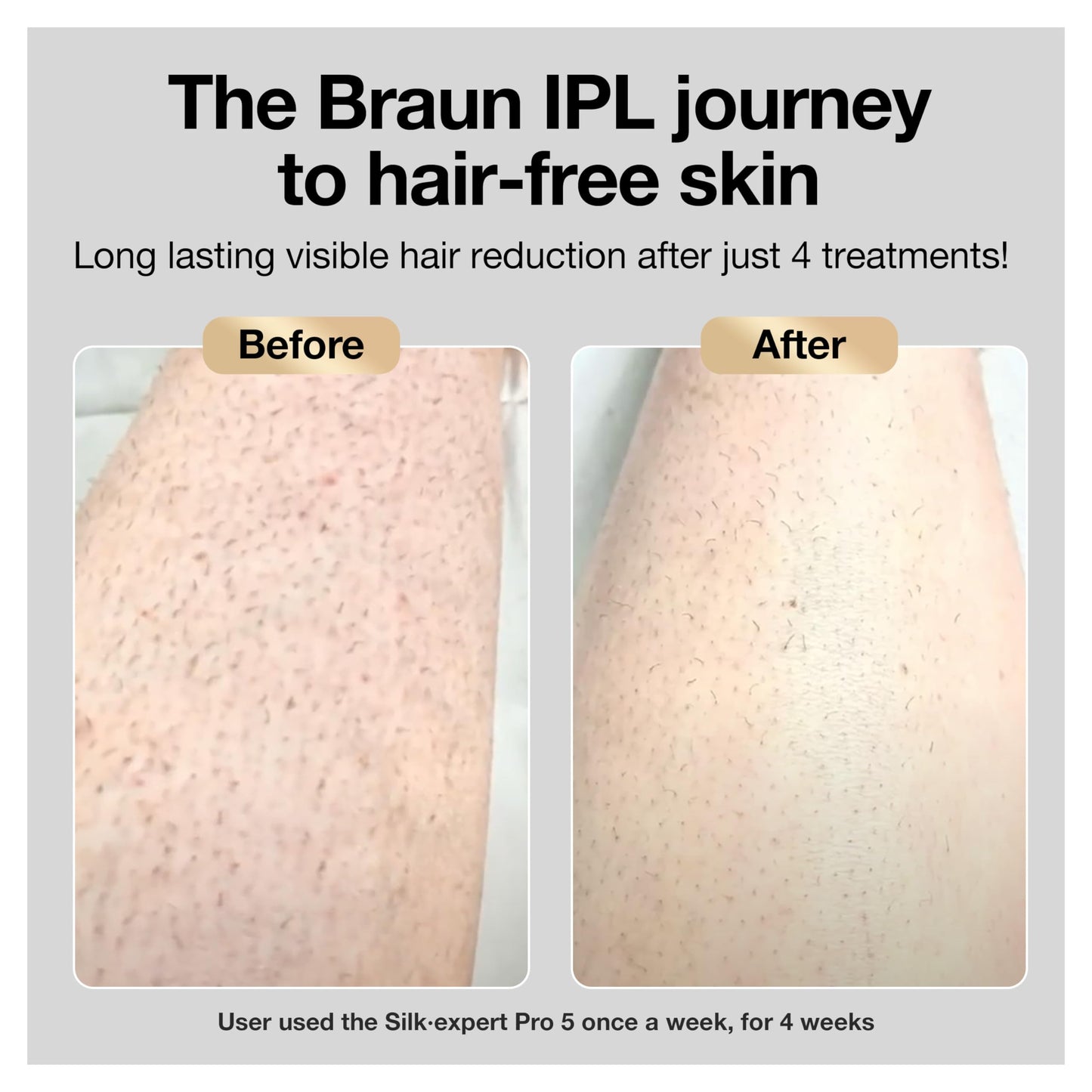 Braun IPL Long-lasting Laser Hair Removal Device for Women & Men, Silk Expert Pro5 PL5157, Safe & Virtually Painless Alternative to Salon Laser Hair Removal, Full Body, With Venus Razor & Luxury Case